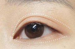 割雙眼皮北京麗都和凱潤婷整形哪家好 割雙眼皮費用