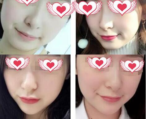 姣蘭玻尿酸的特性大介紹