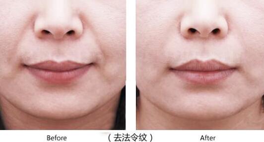 自體脂肪可以填充法令紋嗎?術(shù)后有什么注意事項(xiàng)嗎
