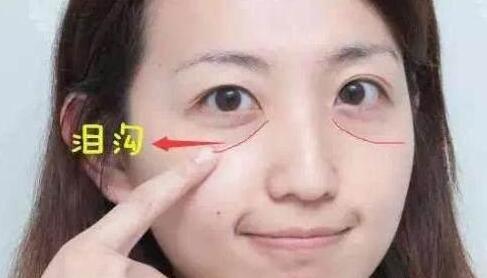 自體脂肪填充淚溝有需要特別注意的嗎?注意事項大全公開