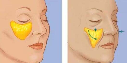 自體脂肪填充淚溝有需要特別注意的嗎?注意事項大全公開