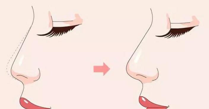 隆鼻和鼻部手術(shù)有什么不同？選擇哪一種手術(shù)方式更好？
