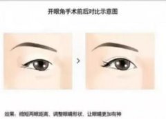 為什么開外眼角人很少?為什么不建議開外眼角?