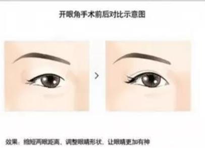 為什么開外眼角人很少?為什么不建議開外眼角?