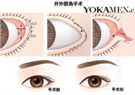 為什么開外眼角人很少?為什么不建議開外眼角?