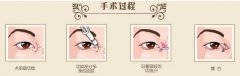 如何避免開外眼角收縮?手術(shù)后如何護(hù)理?