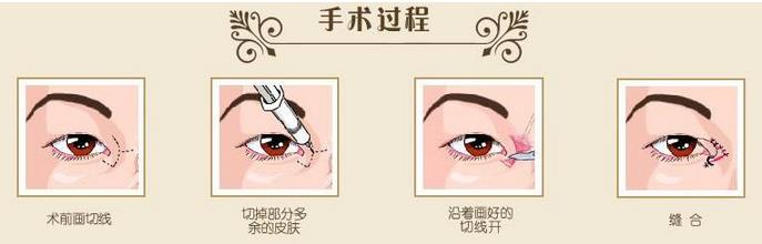 如何避免開外眼角收縮?手術(shù)后如何護(hù)理?
