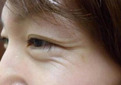 魚尾紋怎么去除?調(diào)節(jié)方法有哪些?