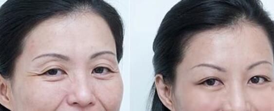 魚尾紋怎么去除?調(diào)節(jié)方法有哪些?