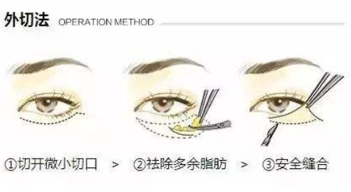 激光和內(nèi)切祛眼袋哪個更持久?
