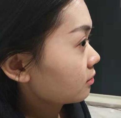 成都奕后孟祥宏醫(yī)生做隆鼻修復(fù)咋樣?僅三個月就宛若天生