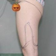 南京美貝爾案例：小姐姐抽脂瘦腿果公開放松