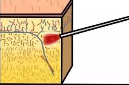 面部光纖溶脂幾年后的危害是什么?提前預(yù)知準沒錯