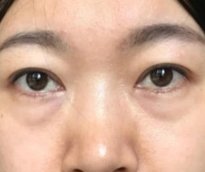 青醫(yī)附院匡瑞霞技術(shù)怎么樣？看祛眼袋真人前后對比圖