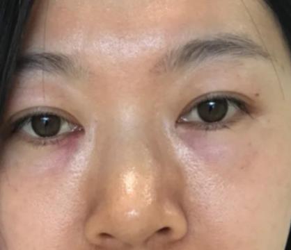 青醫(yī)附院匡瑞霞技術(shù)怎么樣？看祛眼袋真人前后對比圖
