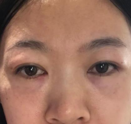 青醫(yī)附院匡瑞霞技術(shù)怎么樣？看祛眼袋真人前后對比圖