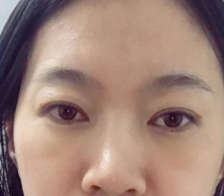 青醫(yī)附院匡瑞霞技術(shù)怎么樣？看祛眼袋真人前后對比圖