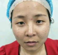 武漢亞韓整形醫(yī)院雙眼皮做的怎么樣？案例前后對比果圖