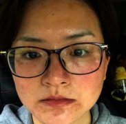 在西南醫(yī)院整形美容科做熱瑪吉，恢復(fù)后感覺年輕了不少