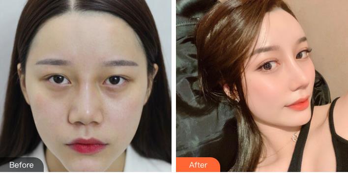 長沙麗都周文亮醫(yī)生做雙眼皮口碑怎么樣