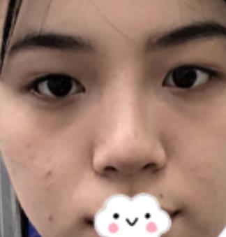 北京趙延勇醫(yī)生口碑好嗎？雙眼皮案例果公布