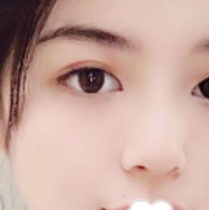 北京趙延勇醫(yī)生口碑好嗎？雙眼皮案例果公布