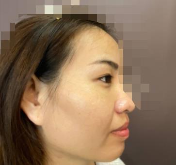 北京楊明勇技術(shù)好嗎？真人親身經(jīng)歷記錄&果展示