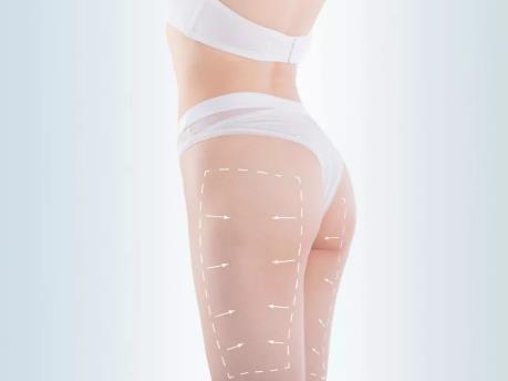 大腿吸脂術(shù)后出現(xiàn)不均勻的情況怎么辦？