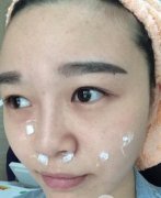 廣州后勤醫(yī)院激光整形美容中心做激光祛斑前后變化圖，還有收費(fèi)明細(xì)