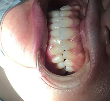 四川省人民醫(yī)院口腔科李崢醫(yī)生咋樣?牙齒矯正費(fèi)用多少?