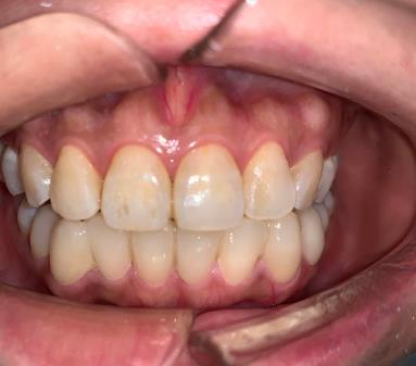 四川省人民醫(yī)院口腔科李崢醫(yī)生咋樣?牙齒矯正費(fèi)用多少?