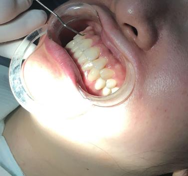 四川省人民醫(yī)院口腔科李崢醫(yī)生咋樣?牙齒矯正費(fèi)用多少?