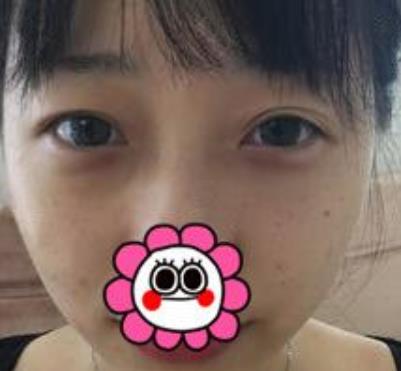 【冷向鋒案例】青醫(yī)附院雙眼皮術(shù)后恢復(fù)記錄公開，速覽