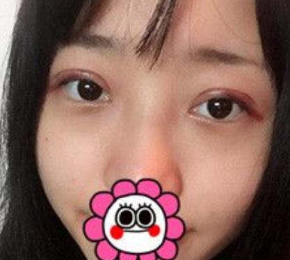 【冷向鋒案例】青醫(yī)附院雙眼皮術(shù)后恢復(fù)記錄公開，速覽