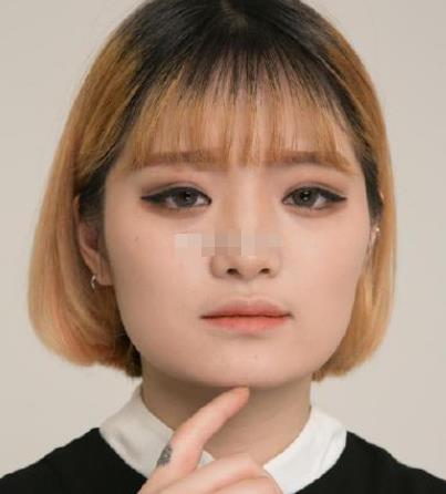 上海九院韋敏磨骨怎么樣?術(shù)后日記經(jīng)驗分享