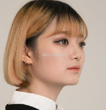 上海九院韋敏磨骨怎么樣?術(shù)后日記經(jīng)驗分享