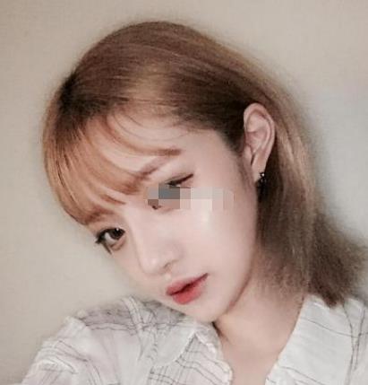 上海九院韋敏磨骨怎么樣?術(shù)后日記經(jīng)驗分享