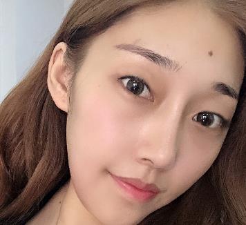 廣州美萊陳貴宗割雙眼皮好嗎?醫(yī)生簡(jiǎn)介+前后對(duì)照?qǐng)D片