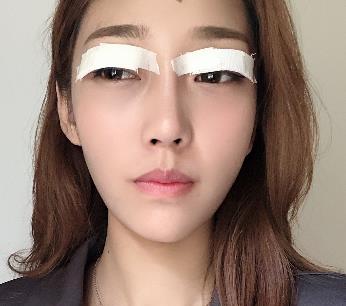 廣州美萊陳貴宗割雙眼皮好嗎?醫(yī)生簡(jiǎn)介+前后對(duì)照?qǐng)D片