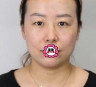 南寧?kù)诿勒吾t(yī)院做埋線雙眼皮真的很自然嗎?果圖實(shí)拍