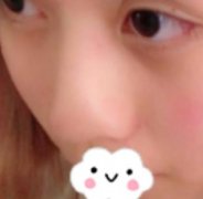 北京301郭伶俐做鼻子好不好？術后一年恢復記錄