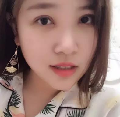 【朱曉峰】雙眼皮做得如何？有術(shù)后四個月案例鑒定果