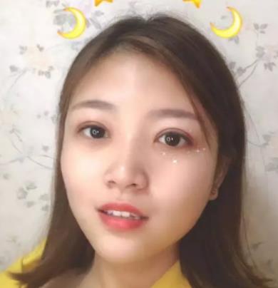 【朱曉峰】雙眼皮做得如何？有術(shù)后四個月案例鑒定果