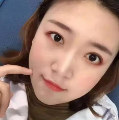 【朱曉峰】雙眼皮做得如何？有術(shù)后四個月案例鑒定果