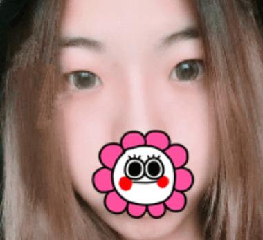 北京八大處滕利做雙眼皮怎么樣？給你們真實日記反饋