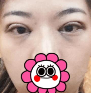 北京八大處滕利做雙眼皮怎么樣？給你們真實日記反饋