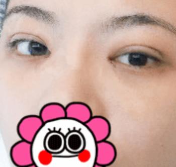 北京八大處滕利做雙眼皮怎么樣？給你們真實日記反饋