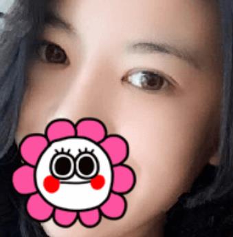 北京八大處滕利做雙眼皮怎么樣？給你們真實日記反饋