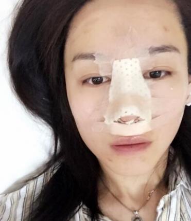 華西醫(yī)院卿勇醫(yī)生隆鼻案例分享，術(shù)后果真實(shí)圖流出