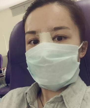 華西醫(yī)院卿勇醫(yī)生隆鼻案例分享，術(shù)后果真實(shí)圖流出